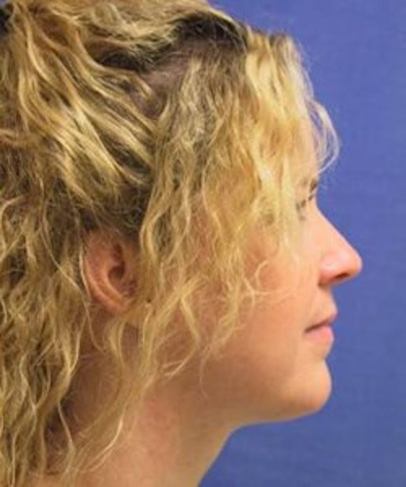 Neck Liposuction Before & After Gallery - Patient 91459375 - Image 2
