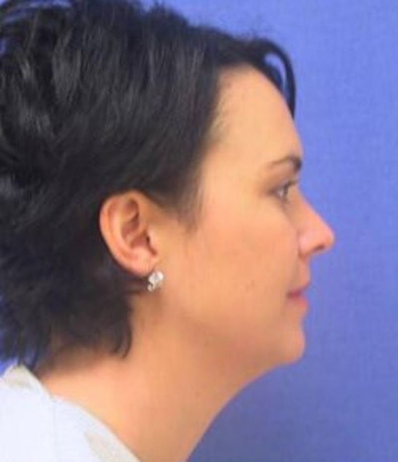 Neck Liposuction Before & After Gallery - Patient 91459376 - Image 1