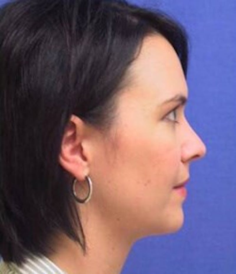 Neck Liposuction Before & After Gallery - Patient 91459376 - Image 2
