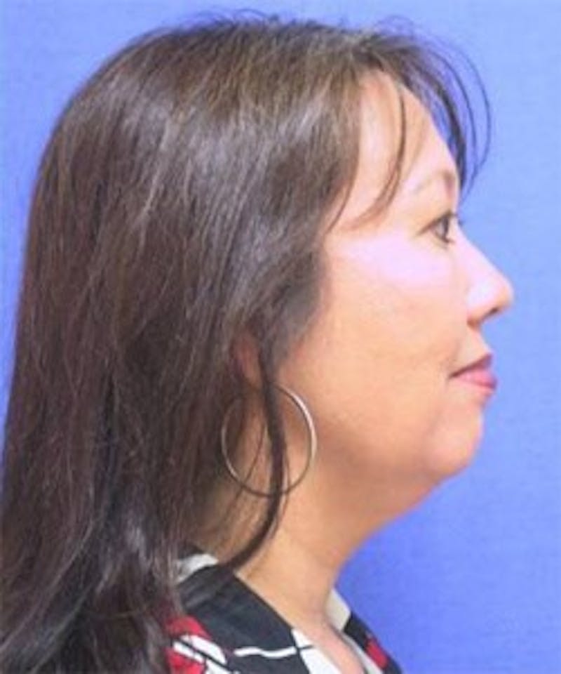 Neck Liposuction Before & After Gallery - Patient 91459377 - Image 1