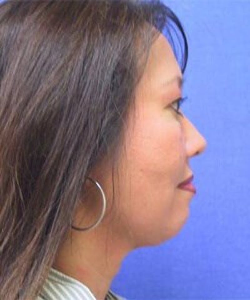 Neck Liposuction Before & After Gallery - Patient 91459377 - Image 2