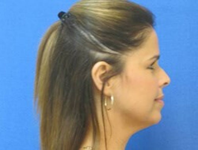 Neck Liposuction Before & After Gallery - Patient 91459379 - Image 1