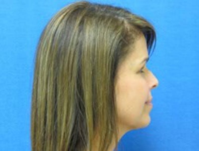 Neck Liposuction Before & After Gallery - Patient 91459379 - Image 2