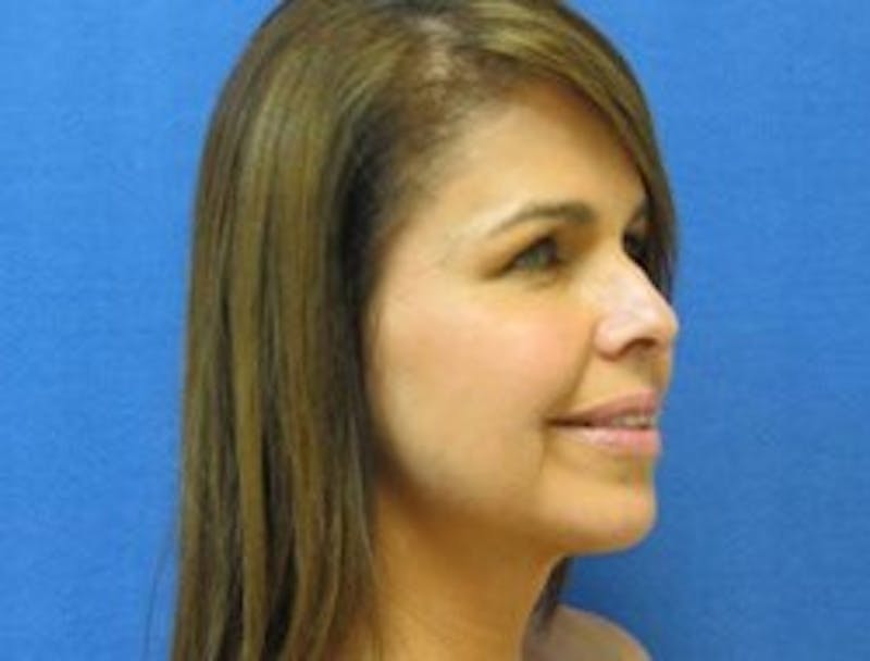 Neck Liposuction Before & After Gallery - Patient 91459379 - Image 4