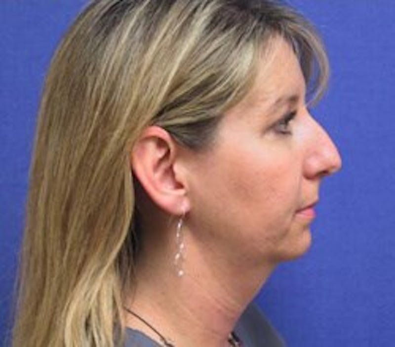 Neck Liposuction Before & After Gallery - Patient 91459383 - Image 1