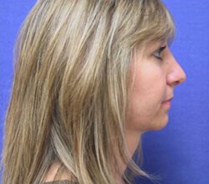 Neck Liposuction Before & After Gallery - Patient 91459383 - Image 2