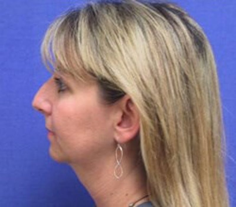 Neck Liposuction Before & After Gallery - Patient 91459383 - Image 3