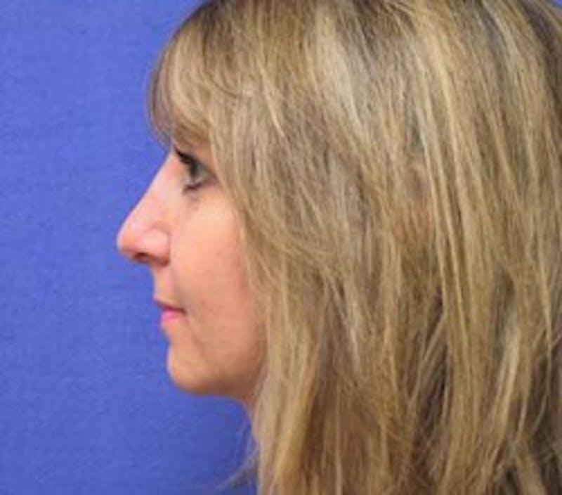 Neck Liposuction Before & After Gallery - Patient 91459383 - Image 4