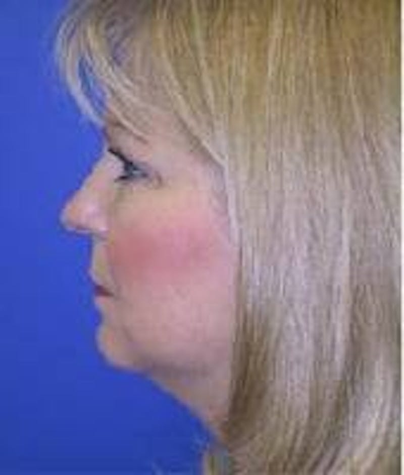Neck Liposuction Before & After Gallery - Patient 91459384 - Image 1