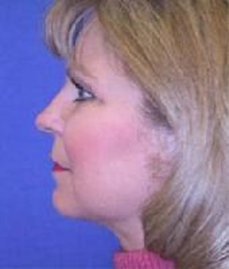 Neck Liposuction Before & After Gallery - Patient 91459384 - Image 2