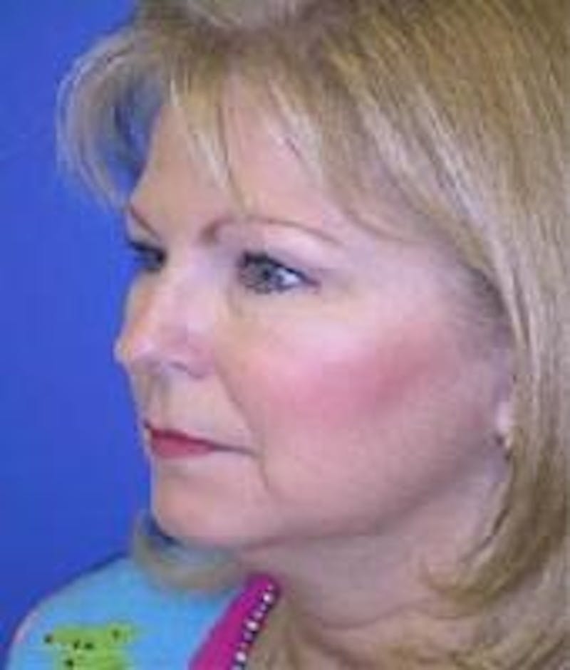 Neck Liposuction Before & After Gallery - Patient 91459384 - Image 3
