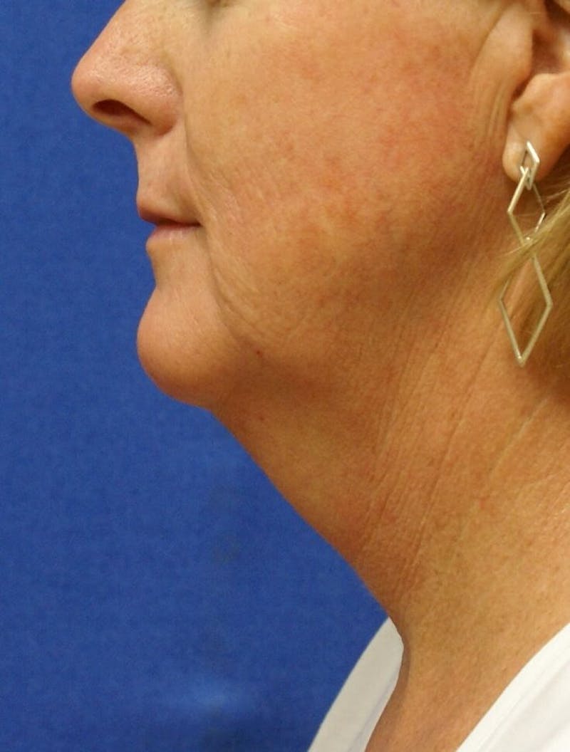Neck Liposuction Before & After Gallery - Patient 91459387 - Image 1