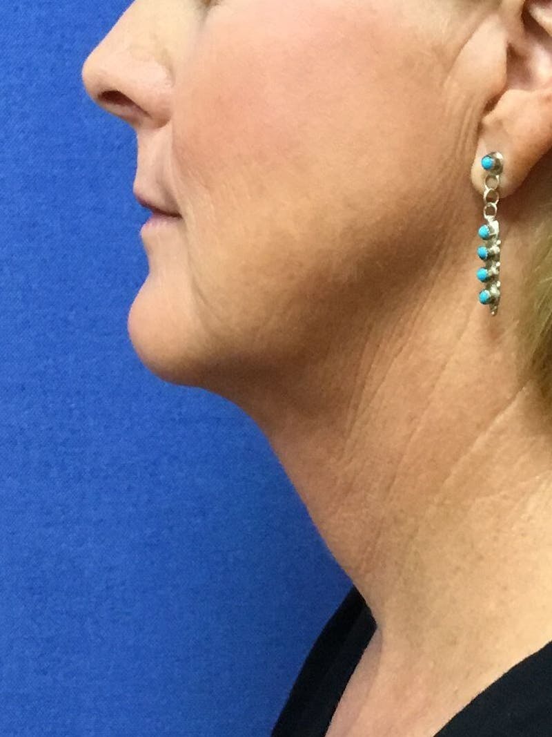 Neck Liposuction Before & After Gallery - Patient 91459387 - Image 2