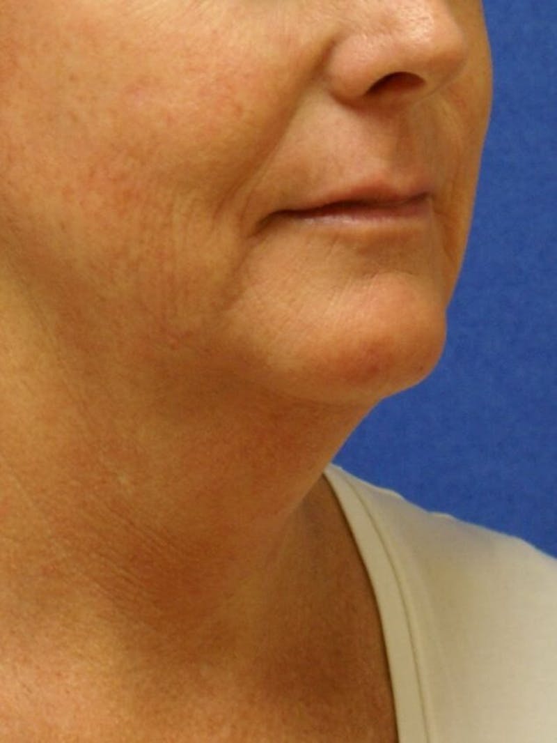 Neck Liposuction Before & After Gallery - Patient 91459387 - Image 3