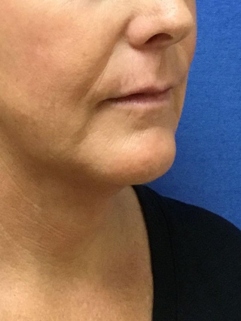 Neck Liposuction Before & After Gallery - Patient 91459387 - Image 4
