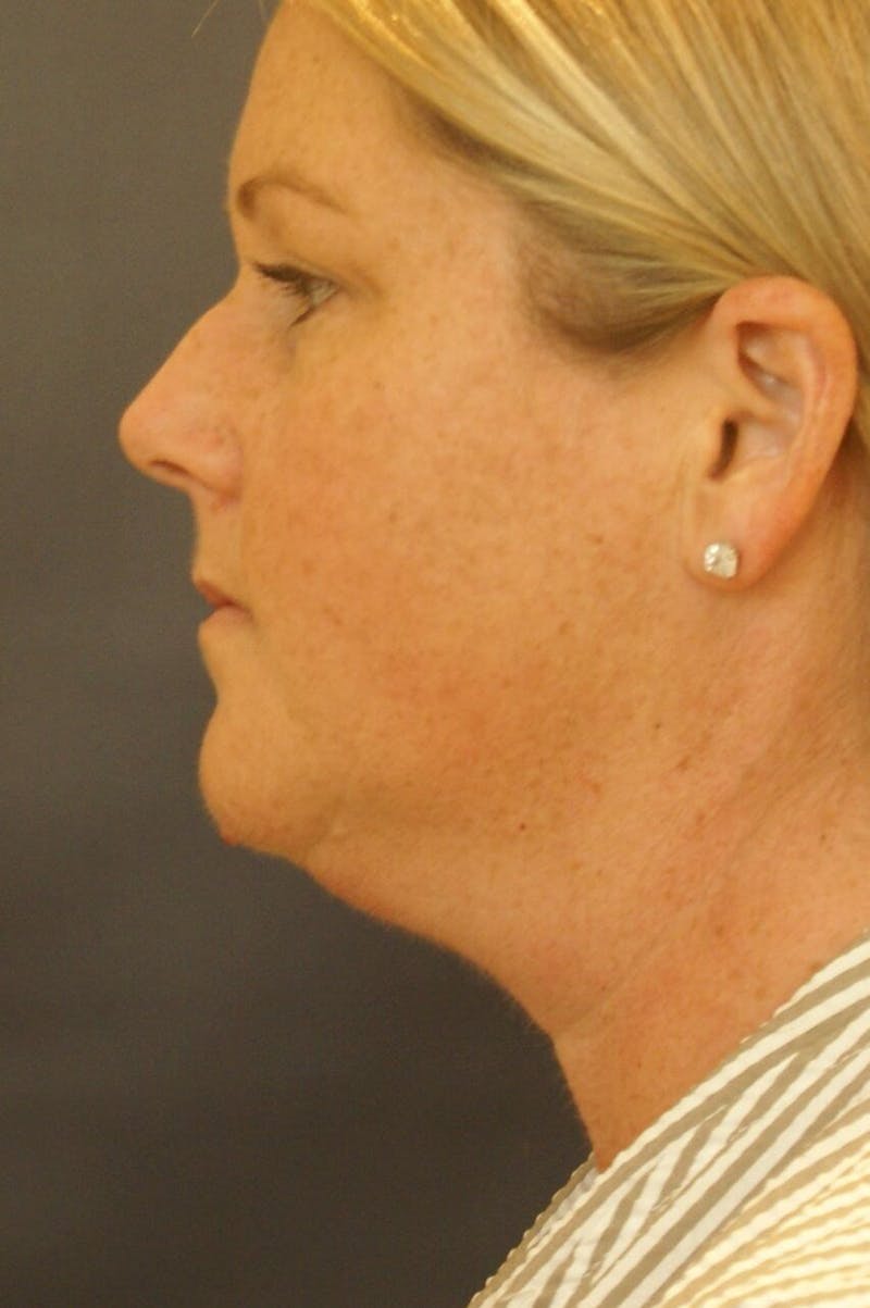 Neck Liposuction Before & After Gallery - Patient 91459389 - Image 1