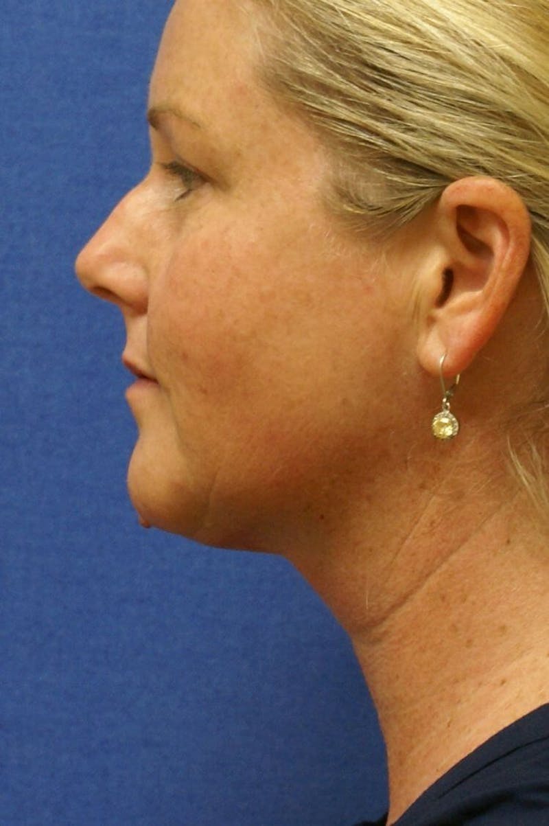 Neck Liposuction Before & After Gallery - Patient 91459389 - Image 2