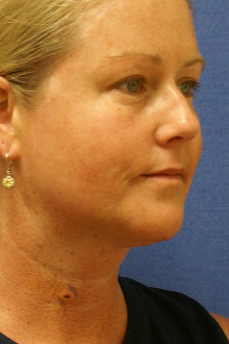 Neck Liposuction Before & After Gallery - Patient 91459389 - Image 4