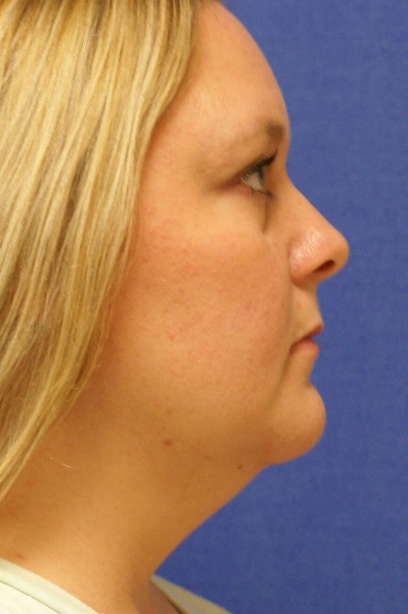 Neck Liposuction Before & After Gallery - Patient 91459391 - Image 1