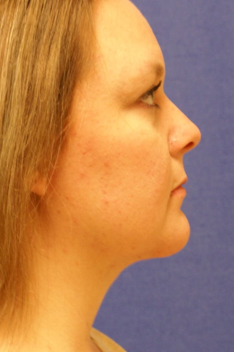 Neck Liposuction Before & After Gallery - Patient 91459391 - Image 2