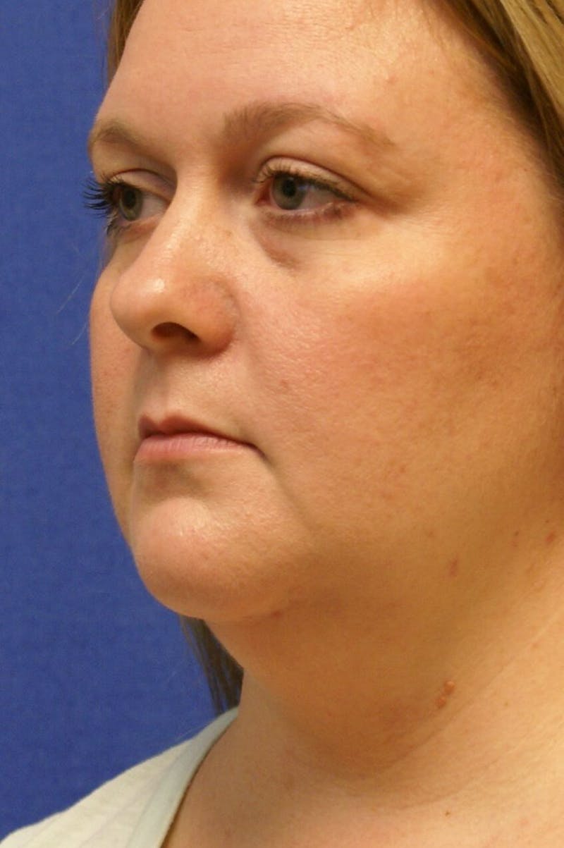 Neck Liposuction Before & After Gallery - Patient 91459391 - Image 3