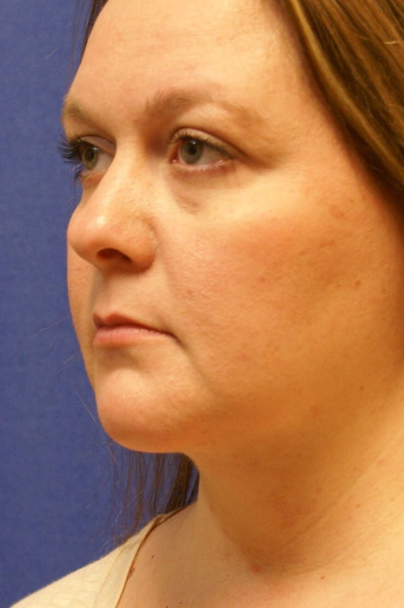Neck Liposuction Before & After Gallery - Patient 91459391 - Image 4