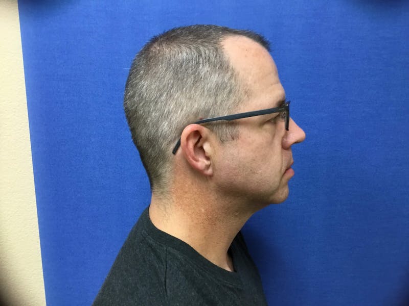 Neck Liposuction Before & After Gallery - Patient 91459392 - Image 2
