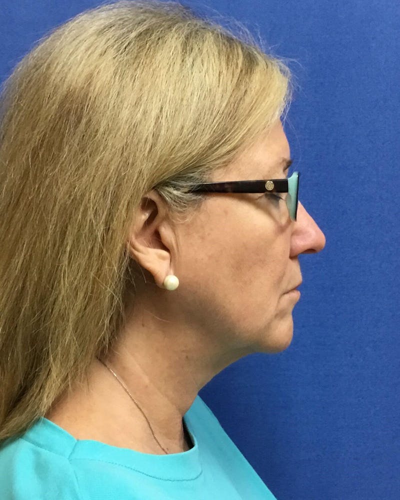 Neck Liposuction Before & After Gallery - Patient 91459393 - Image 2