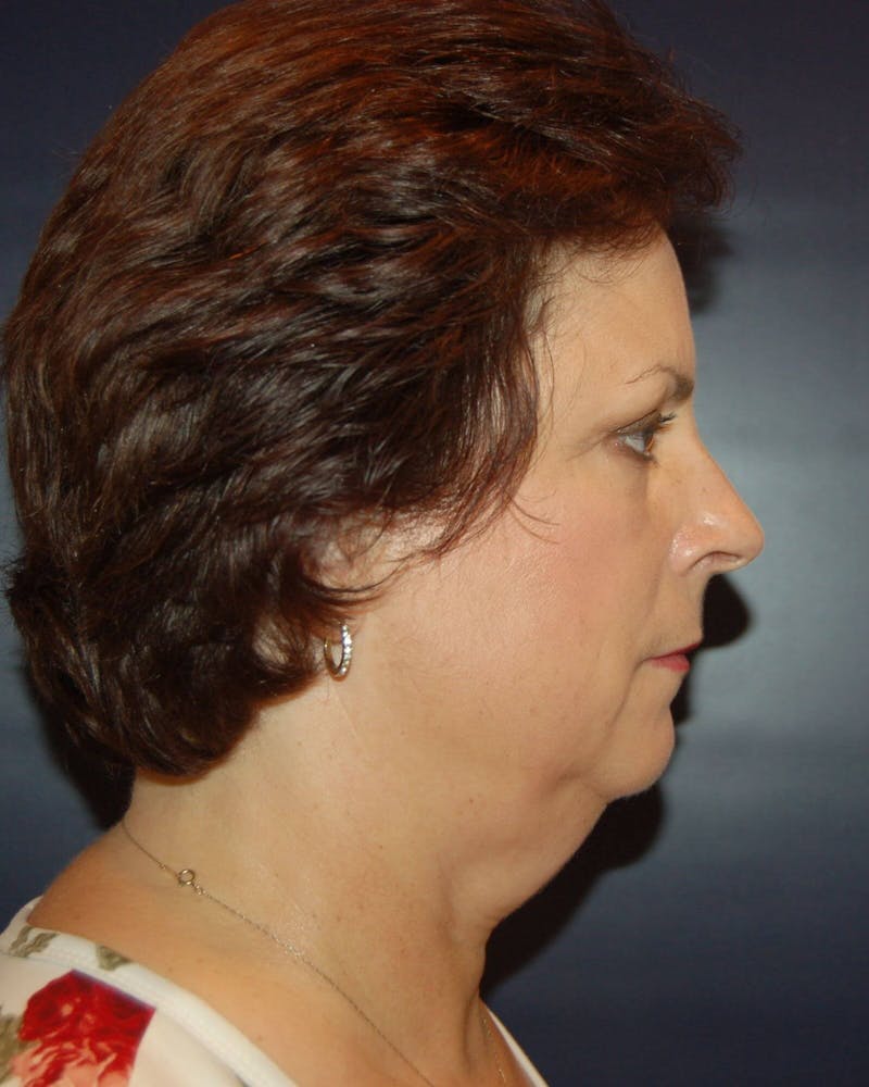 Neck Liposuction Before & After Gallery - Patient 91459394 - Image 1