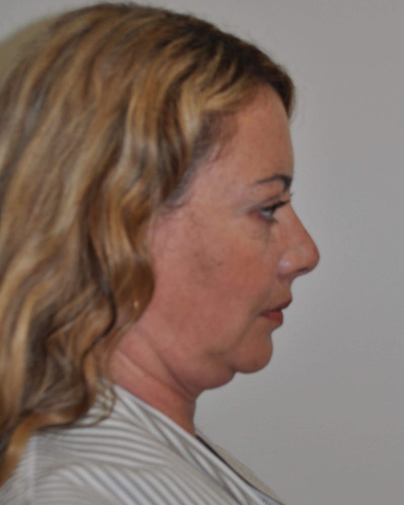 Neck Liposuction Before & After Gallery - Patient 91459395 - Image 1