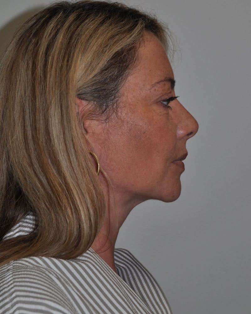 Neck Liposuction Before & After Gallery - Patient 91459395 - Image 2