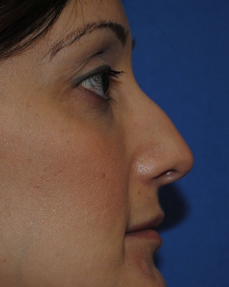 Rhinoplasty Before & After Gallery - Patient 91459409 - Image 1