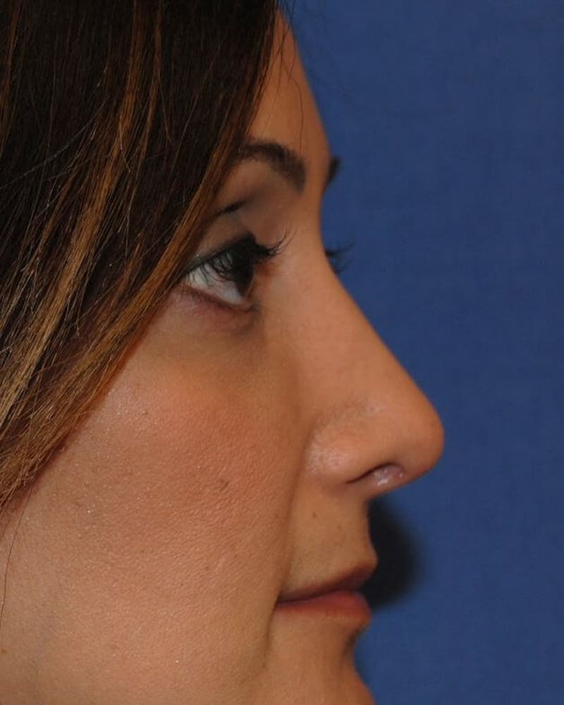 Rhinoplasty Before & After Gallery - Patient 91459409 - Image 2