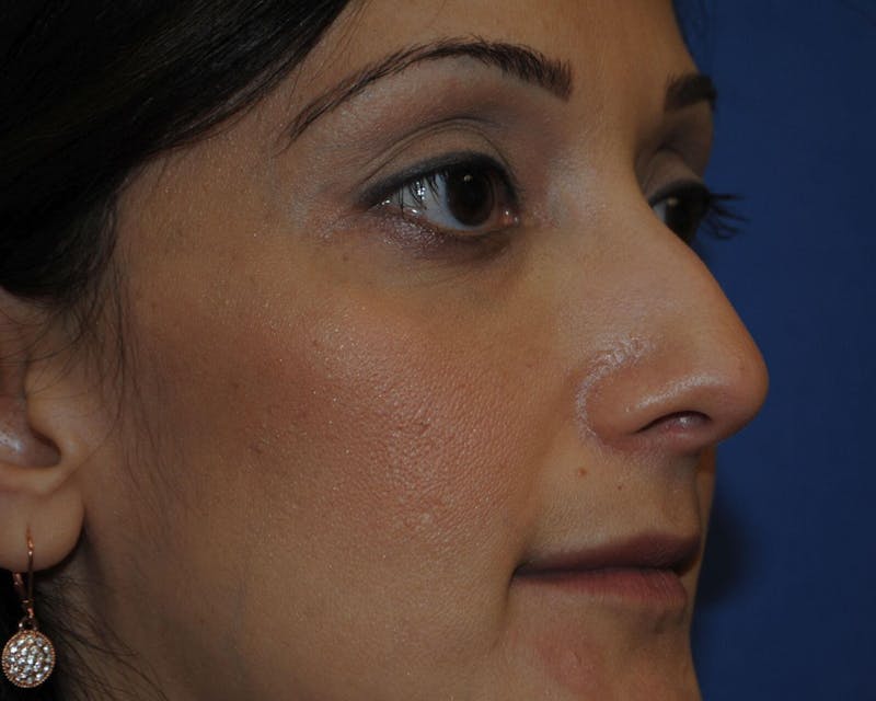 Rhinoplasty Before & After Gallery - Patient 91459409 - Image 3