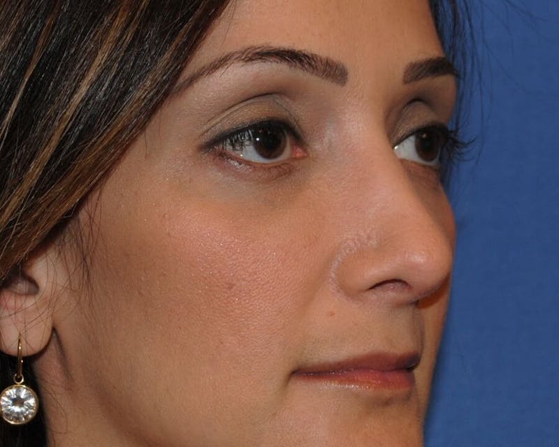 Rhinoplasty Before & After Gallery - Patient 91459409 - Image 4