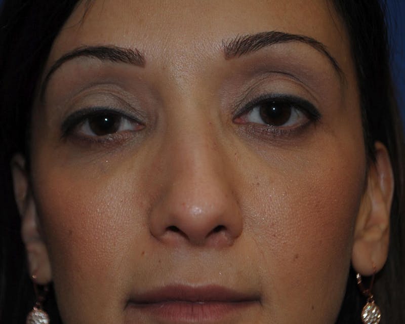 Rhinoplasty Before & After Gallery - Patient 91459409 - Image 5