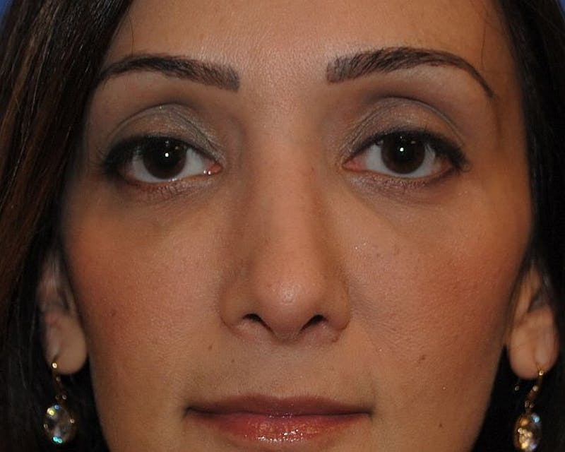 Rhinoplasty Before & After Gallery - Patient 91459409 - Image 6