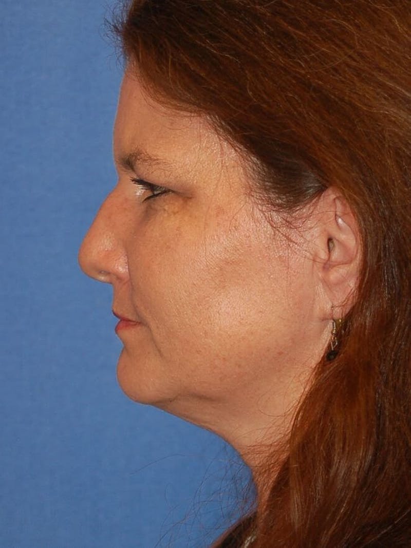 Rhinoplasty Before & After Gallery - Patient 91459440 - Image 1
