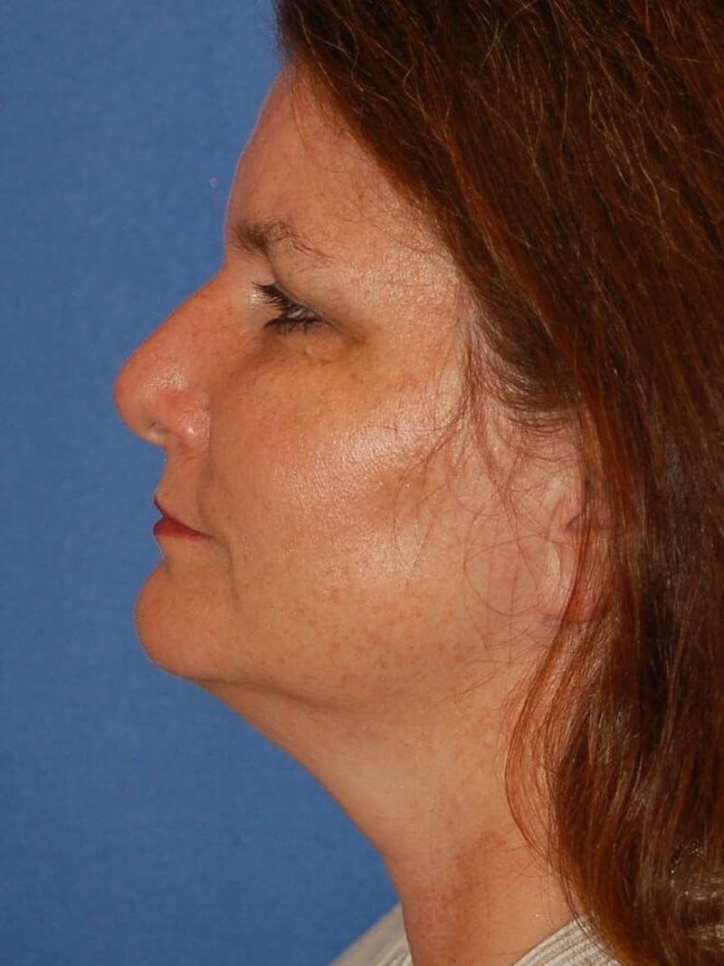 Rhinoplasty Before & After Gallery - Patient 91459440 - Image 2