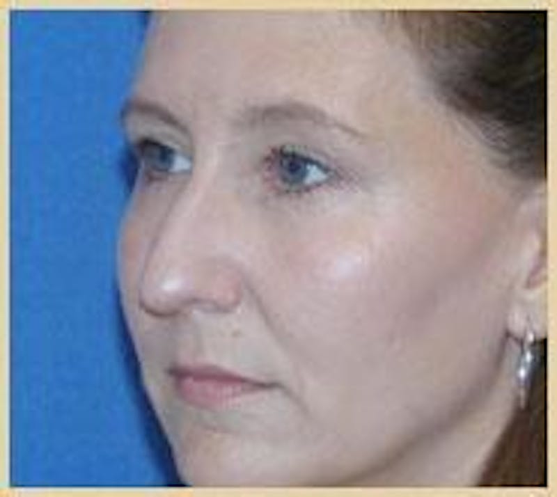 Rhinoplasty Before & After Gallery - Patient 91459442 - Image 3