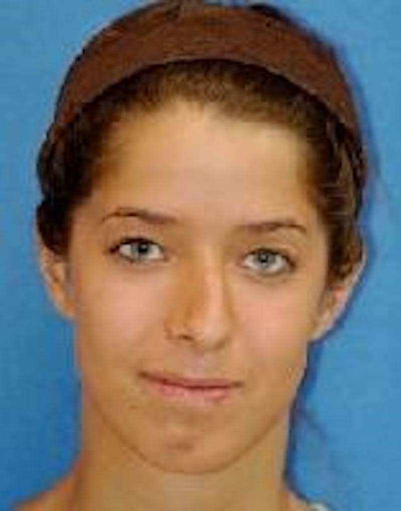 Rhinoplasty Before & After Gallery - Patient 91459443 - Image 1