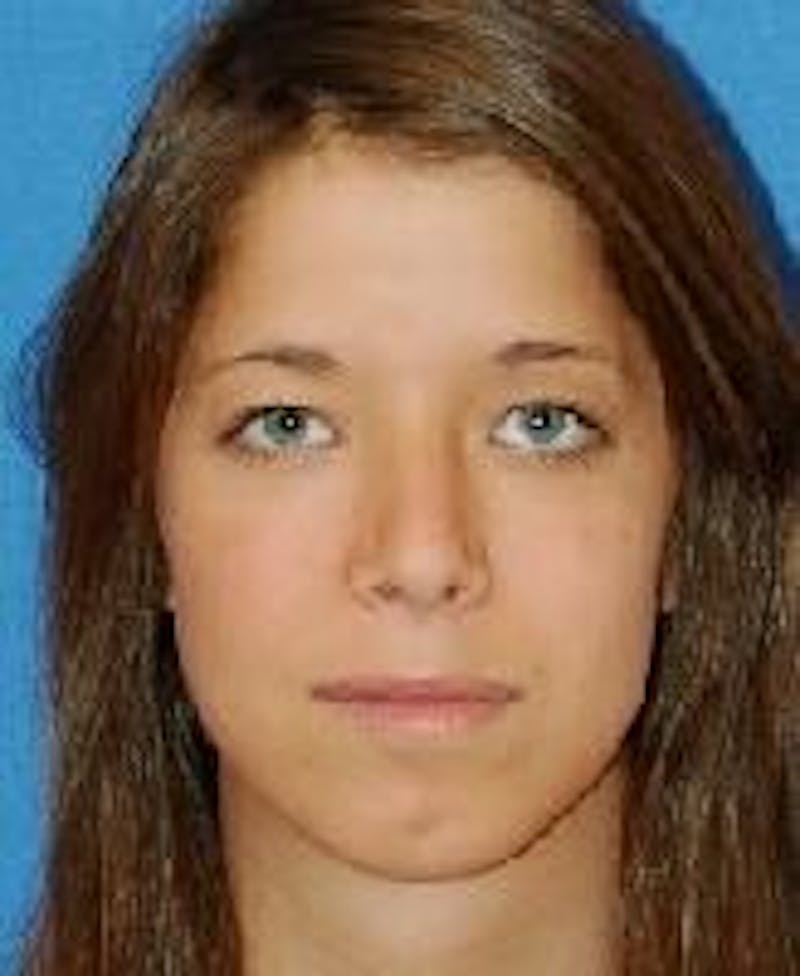 Rhinoplasty Before & After Gallery - Patient 91459443 - Image 2