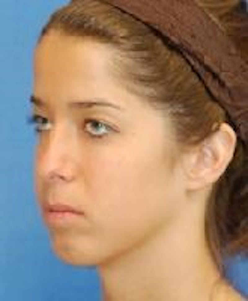 Rhinoplasty Before & After Gallery - Patient 91459443 - Image 3