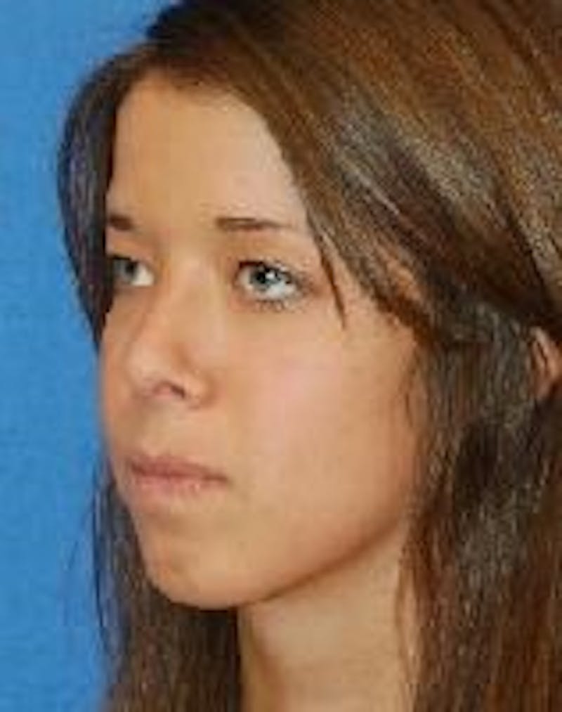 Rhinoplasty Before & After Gallery - Patient 91459443 - Image 4