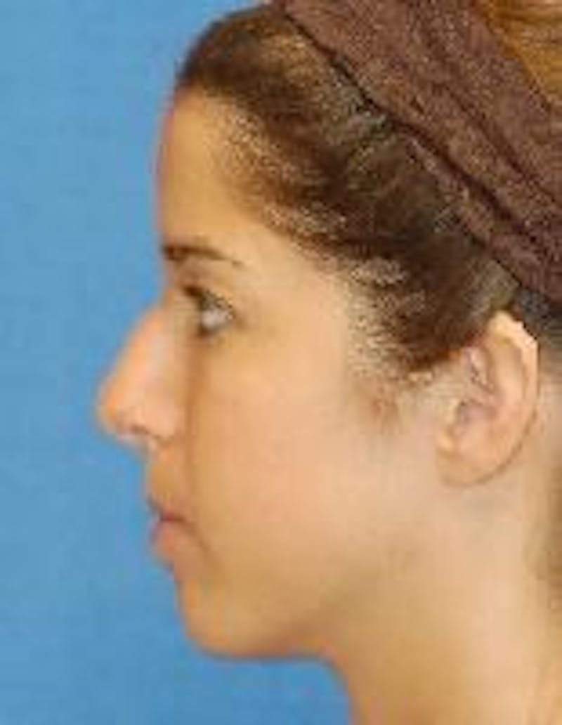 Rhinoplasty Before & After Gallery - Patient 91459443 - Image 1