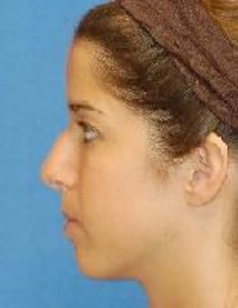 Rhinoplasty Before & After Gallery - Patient 91459443 - Image 5