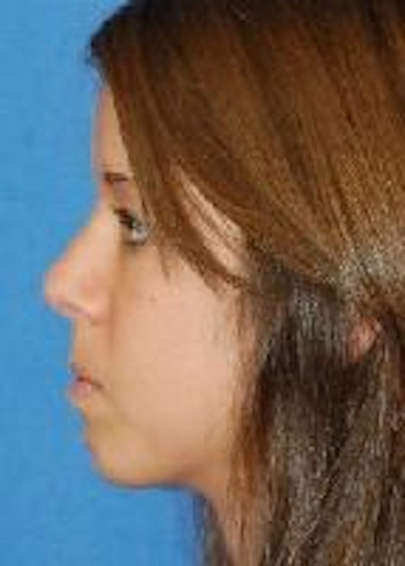 Rhinoplasty Before & After Gallery - Patient 91459443 - Image 2