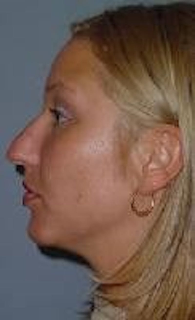 Rhinoplasty Before & After Gallery - Patient 91459446 - Image 1