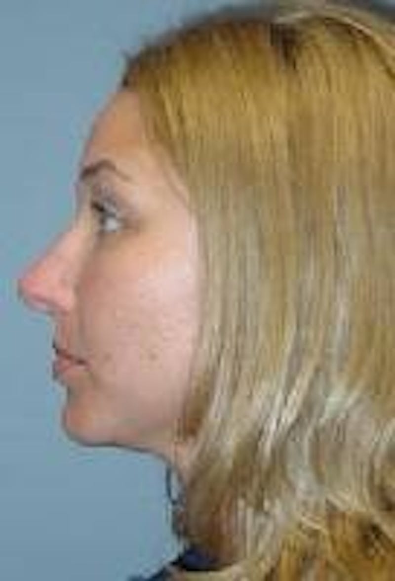 Rhinoplasty Before & After Gallery - Patient 91459446 - Image 2