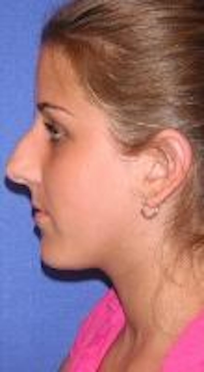 Rhinoplasty Before & After Gallery - Patient 91459477 - Image 1